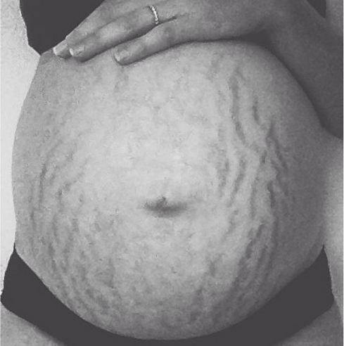 Love Your Lines Instagram Inspires Women To Love Their Stretch Marks