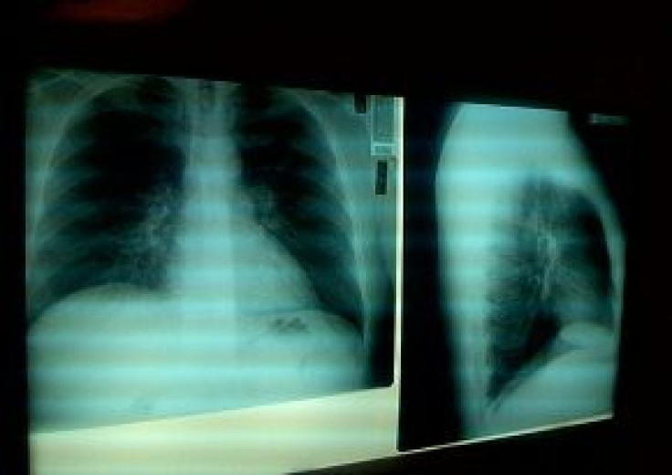 Study finds evidence of increased lung cancer risk among tuberculosis patients