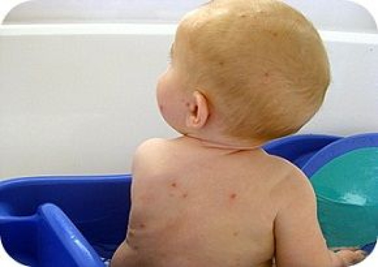 Yale researchers find double doses of chicken pox vaccine most effective