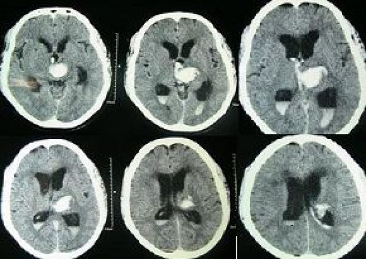 Statin risks may outweigh benefits for patients with a history of brain hemorrhage