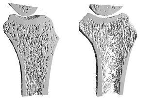 Link between fracture prevention and treatment adherence not fully understood by patients