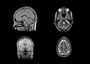 Virus might fight brain tumors better if armed with bacterial enzyme