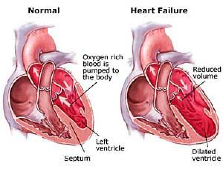 Kidney gene implicated in increased heart failure risk
