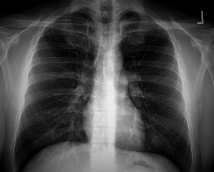 Anti-estrogen medication reduces risk of dying from lung cancer