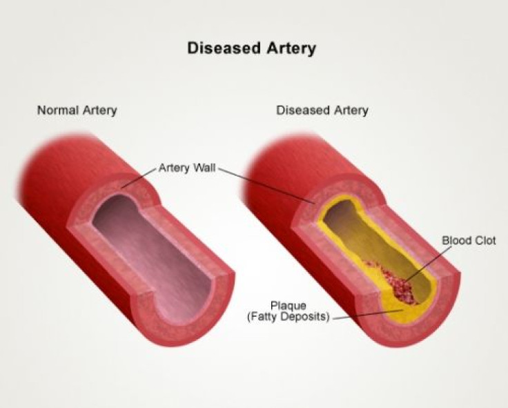 NIH researchers identify genetic cause of new vascular disease