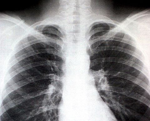 Cancer breakthrough to prevent heart failure and increase survival rates