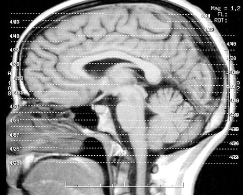 The cerebellum provides clues to the nature of human intelligence
