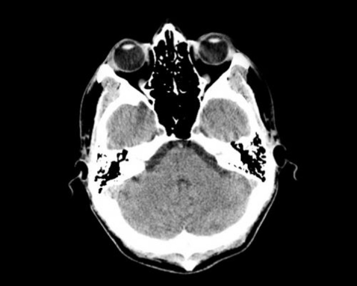 UTHealth study: Stem cells may provide treatment for brain injuries