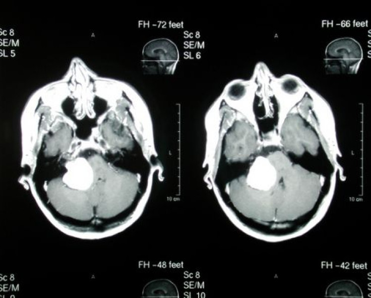 Key mutations act cooperatively to fuel aggressive brain tumor