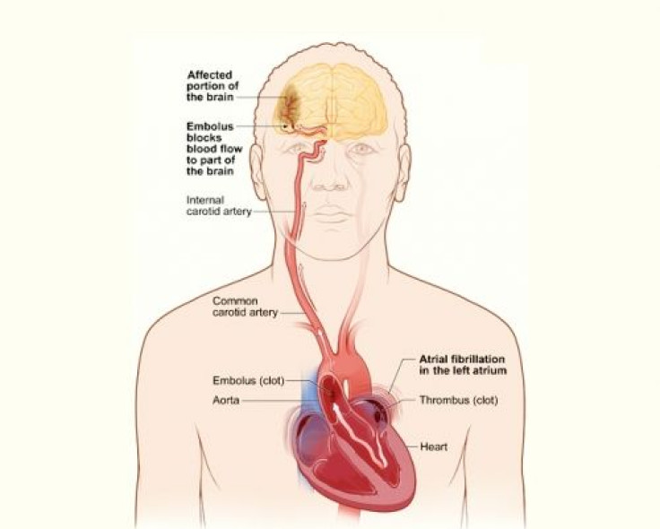 Studies on heart disease and stroke prevention overlook ethnic groups: Study