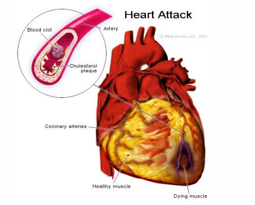 Outcomes improved by longer delays between heart attacks and elective surgeries