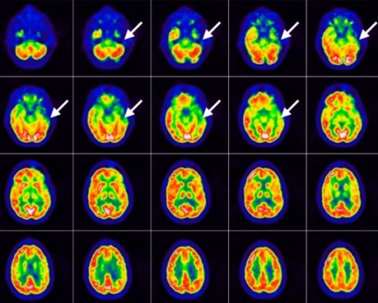 Higher prevalence of psychiatric symptoms found in children with epilepsy