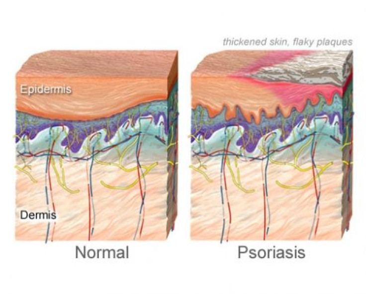 Severe psoriasis linked to major adverse cardiovascular events