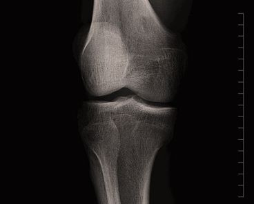 Injectable gel could spell relief for arthritis sufferers