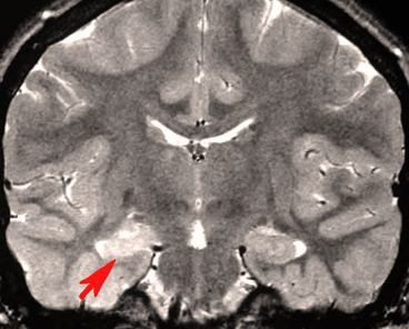 Mortality rate is increased in persons with autism who also have epilepsy