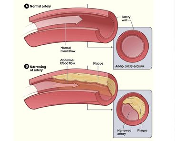 'Bad' cholesterol not as bad as people think, shows Texas A&M study