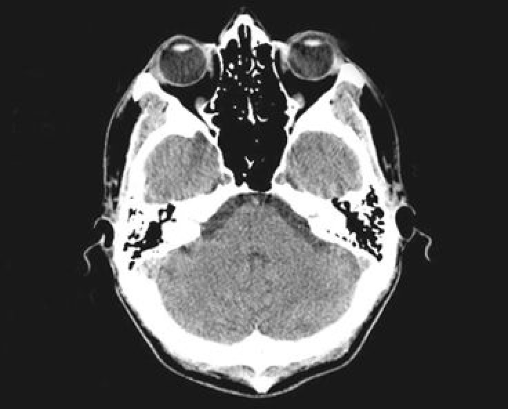 New X-ray method for understanding brain disorders bette