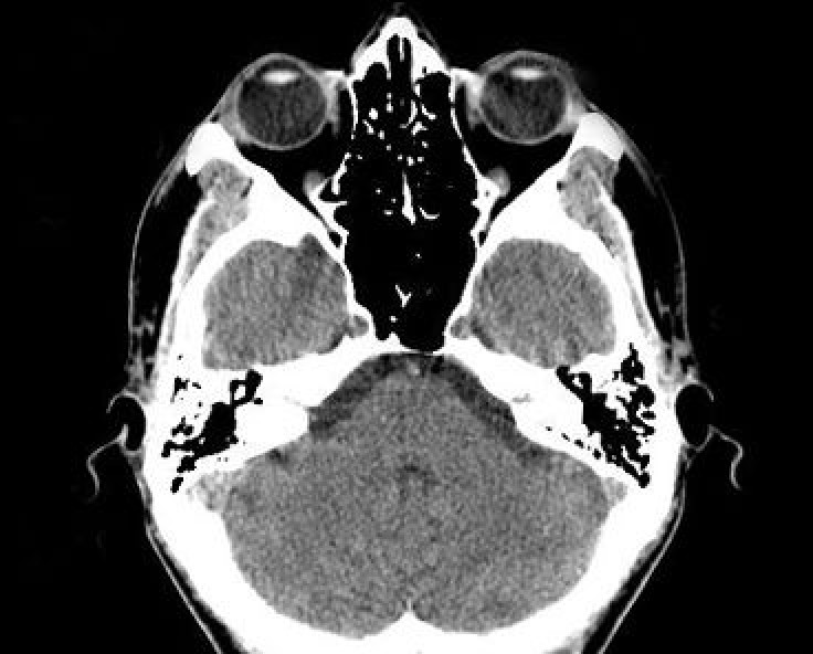 People who have had head injuries report more violent behavior