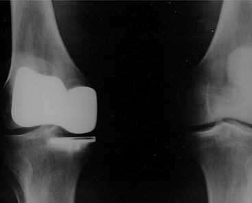 ACSM: Stronger hips improved running mechanics, lessened knee pain