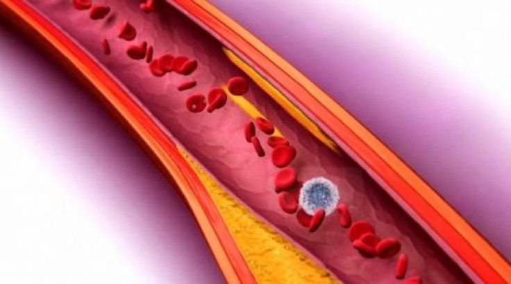 Lumen - Artery - AstraZeneca - Crestor