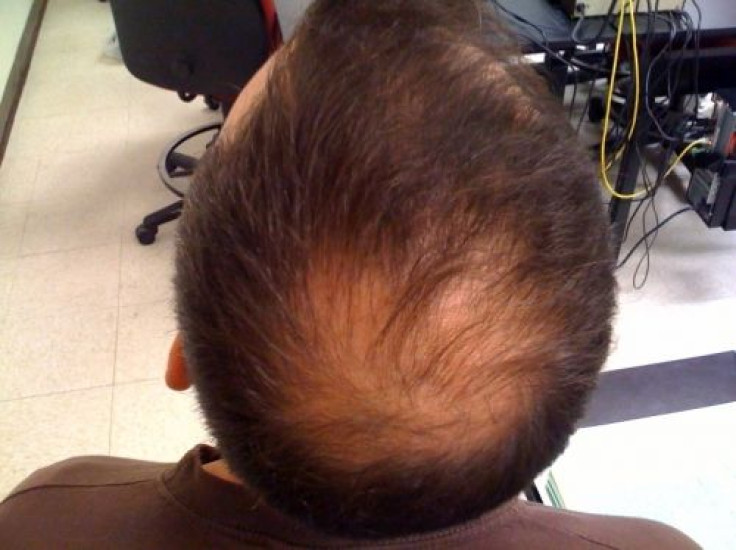 Male Pattern Baldness