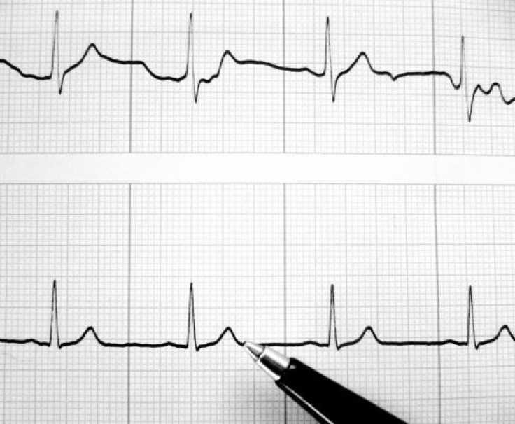 Electrocardiogram