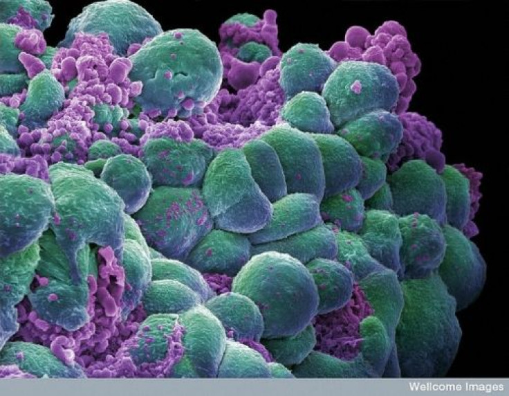 Breast cancer cells.