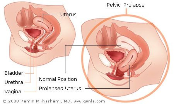 Pelvic Prolapse