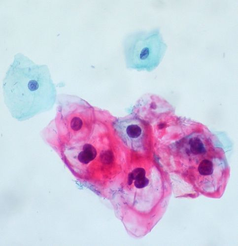 CIN 1/HPV on ThinPrep