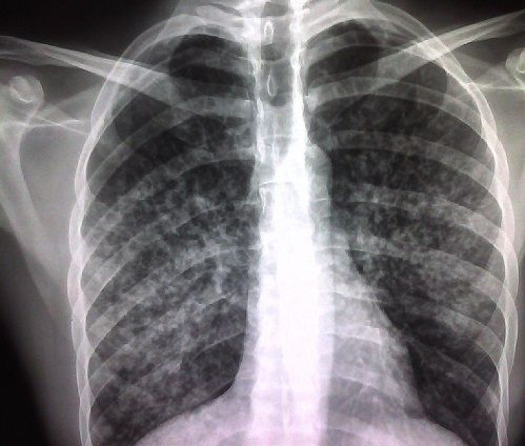 X ray show a possible case of tuberculosis.