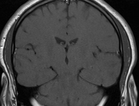 Brain