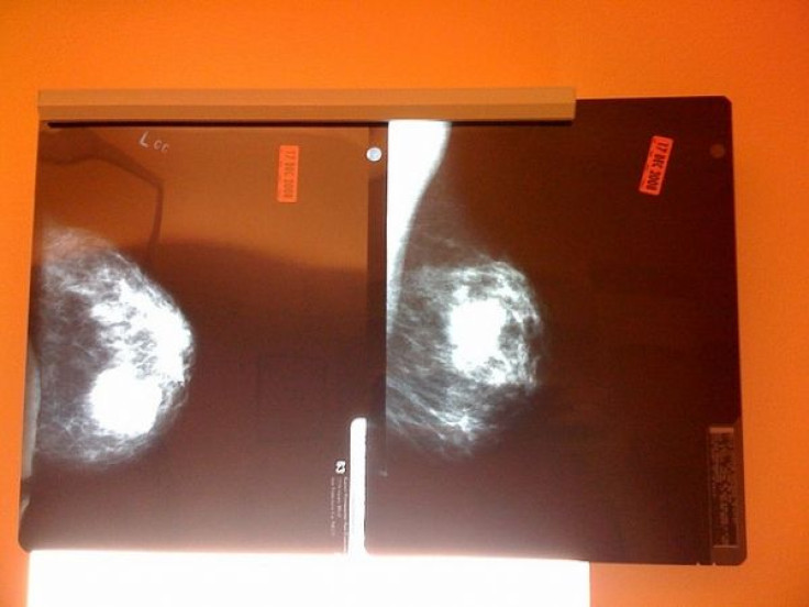 Mammogram.