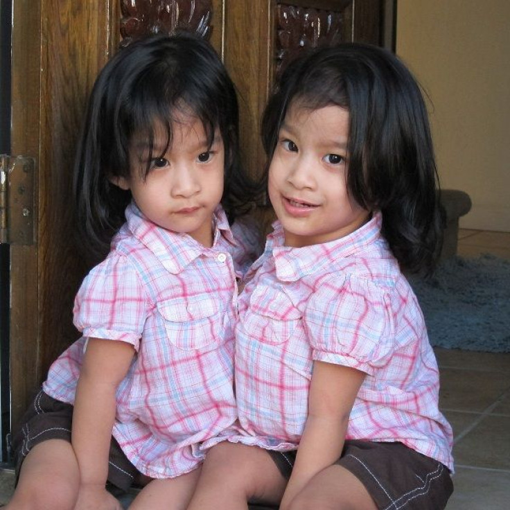 Angelina and Angelica Sabuco are conjoined twins. They will undergo a separation surgery at Lucile Packard Children's Hospital on November 1, 2011.