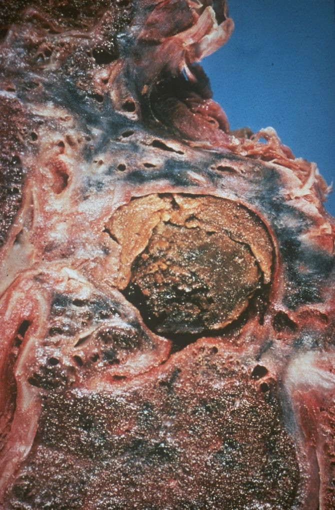 Aspergilloma Complicating Tuberculosis