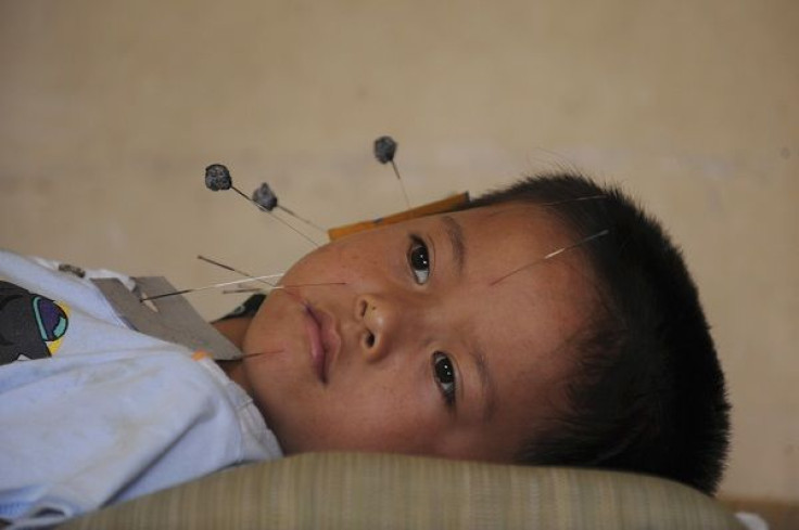 A child receives traditional Chinese acupuncture treatment for curing a facial twitch at a hospital in Jiaxing, Zhejiang province July 8, 2009. Picture taken July 8, 2009.