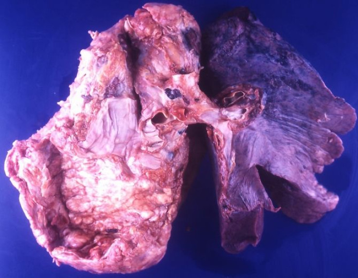 Lungs