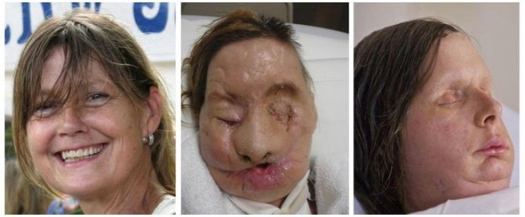 Combination photo shows face transplant recipient Charla Nash before her injury, and before and after her surgery