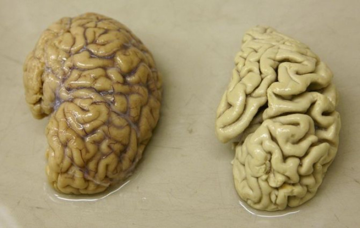 One hemisphere of a healthy brain (L) is pictured next to one hemisphere of a brain of a person suffering from Alzheimer disease