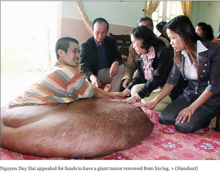 Nguyen Duy Hai appealed for funds to have a giant tumor removed from his leg.