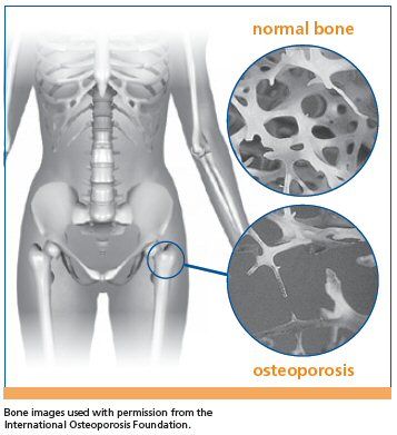 The effects of osteoporosis