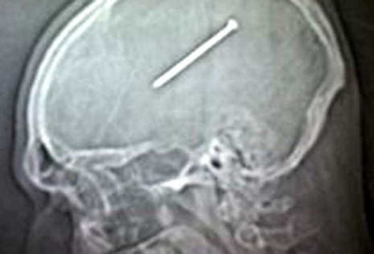 X-ray of Dante Autullo's head after he shot himself with a nail gun.