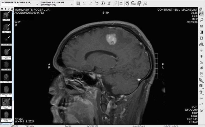 Brain Tumor
