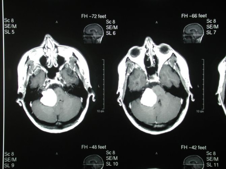 Brain Tumor