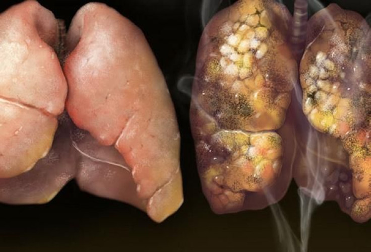 This handout photograph, released on November 10, 2010, depicts diseased lungs in one of the Federal Drug Administration's proposed new &quot;graphic health warnings.&quot;