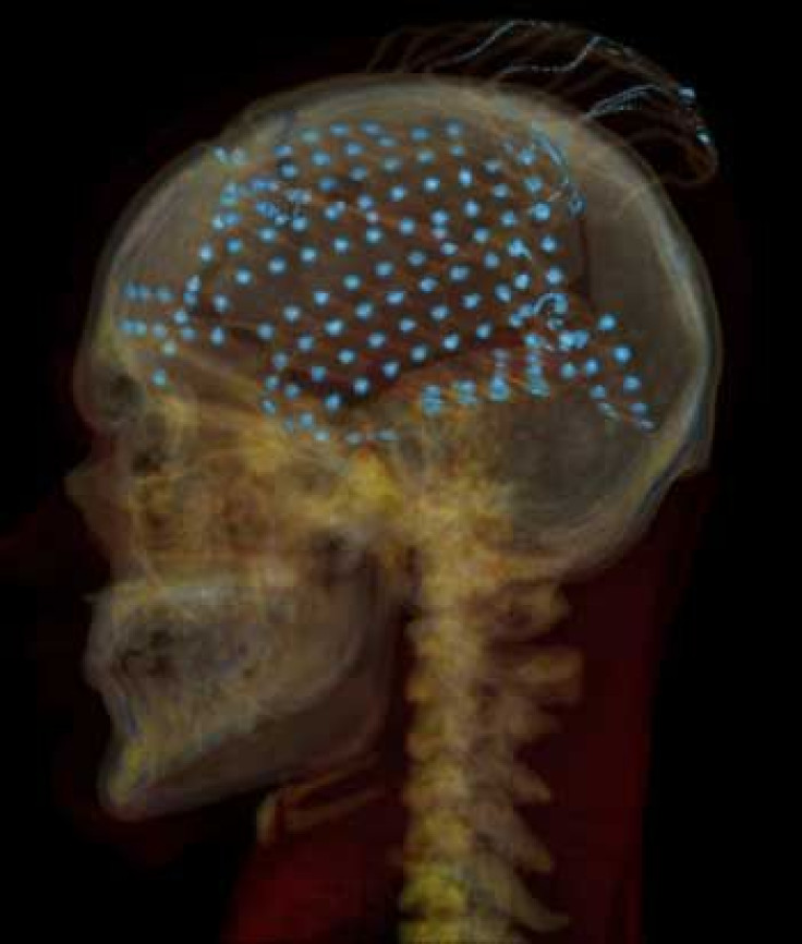 An X-ray CT scan of the head of one of the volunteers, showing electrodes distributed over the brain's temporal lobe, where sounds are processed.