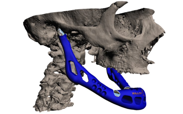 Computer generated 3D image of the patient with the final design of the implant in blue.