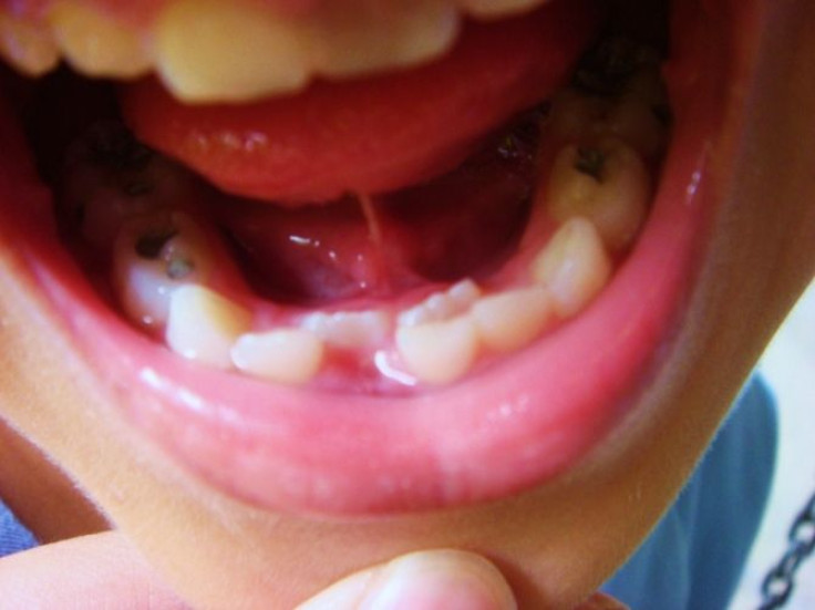 A picture of a child showing off a missing tooth.