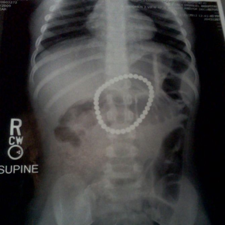 Payton Bushnell's stomach X-ray.
