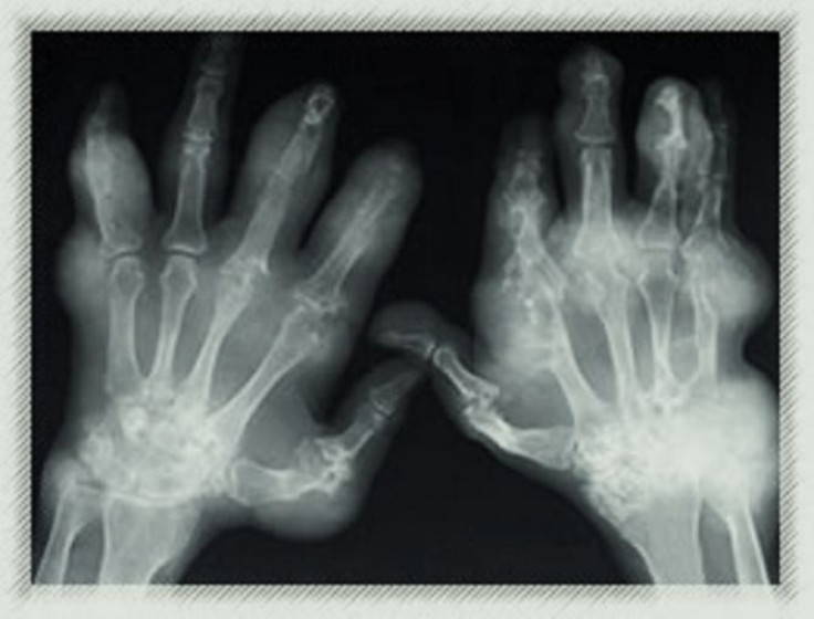 Image showing an x-ray of arthritic hands.