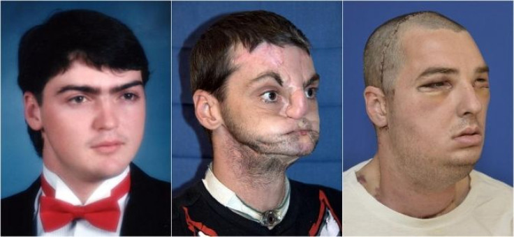 Combination of undated handout photos released by the University of Maryland Medical Center shows face transplant patient Richard Norris at various stages of his life